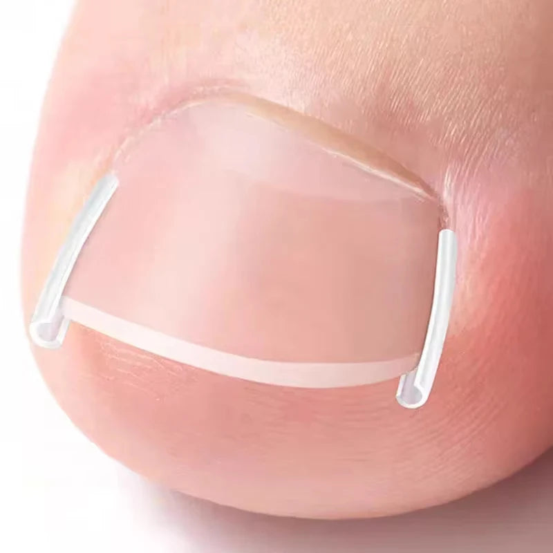 50Pcs Inward Toe Nail Shaping Tool Invisible Nail Care Pad Groove Adjust Clip Accessory Foot Care Tool
