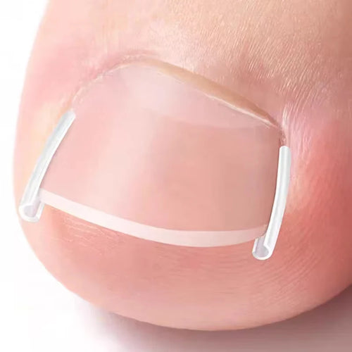 50Pcs Inward Toe Nail Shaping Tool Invisible Nail Care Pad Groove Adjust Clip Accessory Foot Care Tool