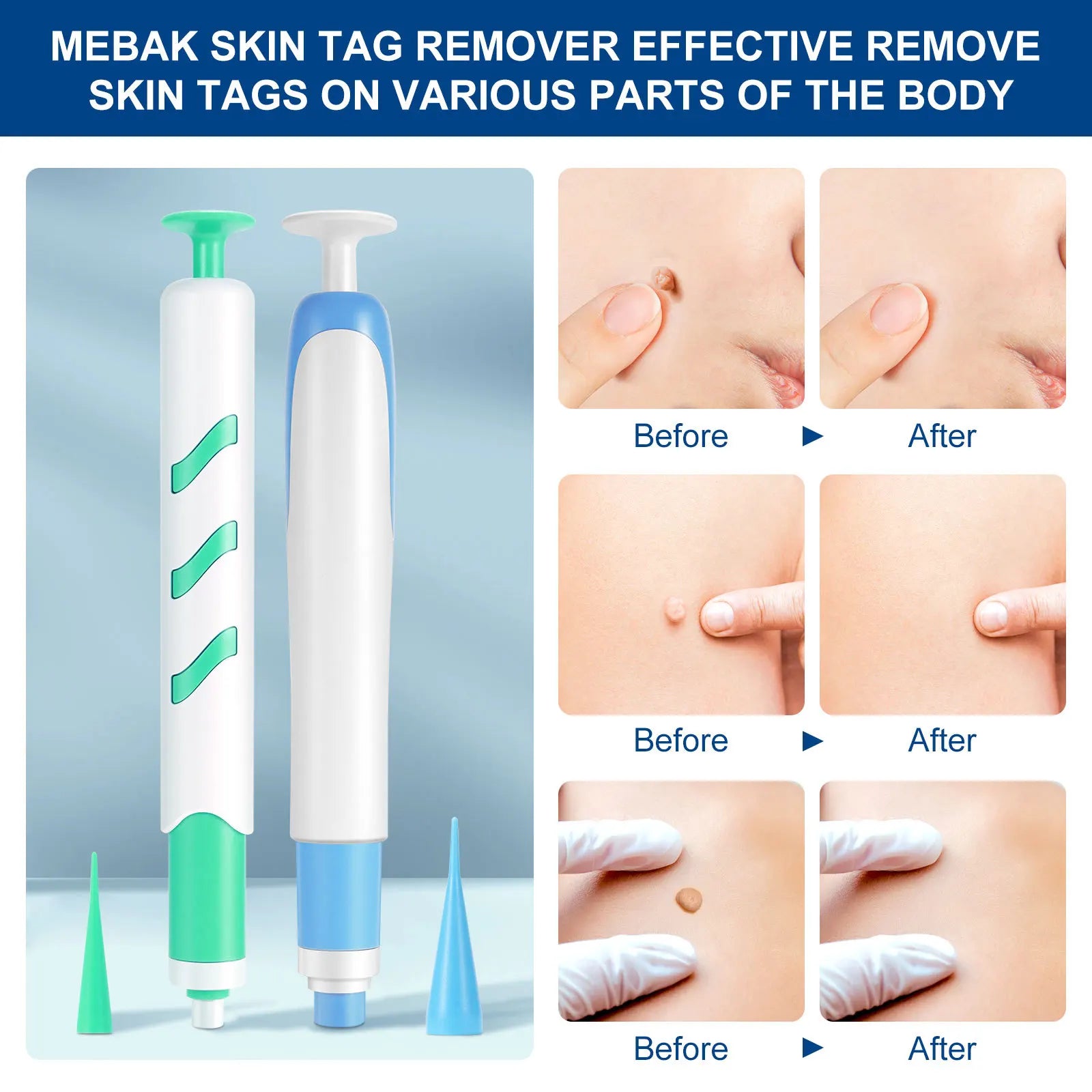 Skin Tags Remover Auto Skin Tags Removal Kit Wart Removal With 30 Small And Large Skin Tags Bands For 1-9mm Groins Small Warts